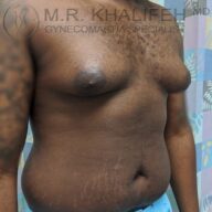A man with visible gynecomastia and stretch marks on the abdomen stands shirtless in a medical setting.