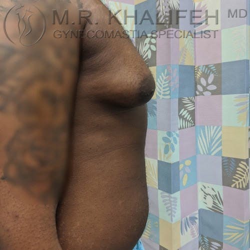A person with gynecomastia, showing enlarged breast tissue on the left side of the chest, standing in front of a patterned curtain.