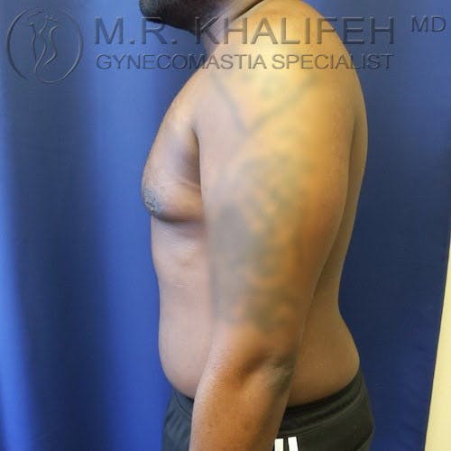 A man with gynecomastia stands in profile against a blue background, with the left arm showing a visible tattoo.
