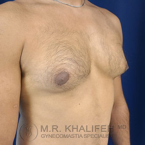 A shirtless male torso with visible gynecomastia, showing enlarged breast tissue on both sides.