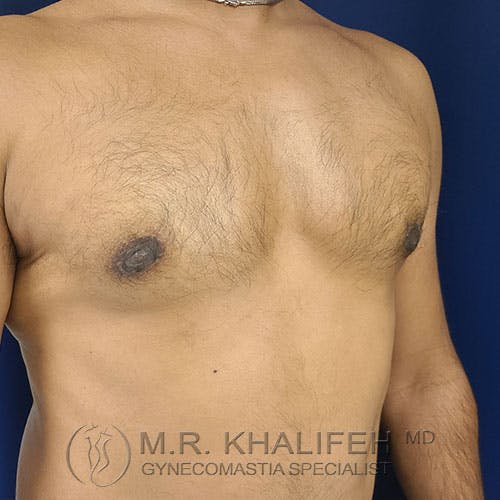 A shirtless male chest displaying signs of gynecomastia, with visible enlargement of breast tissue; blue background and watermark indicating a gynecomastia specialist.
