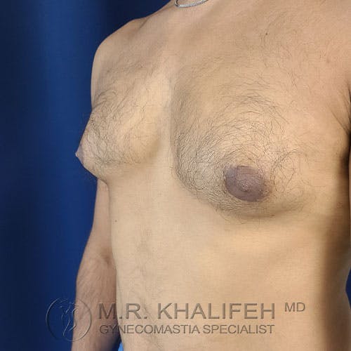 A shirtless person with visible gynecomastia on the left side of their chest, standing against a blue background. Text at the bottom reads "M.R. Khalifeh MD Gynecomastia Specialist.