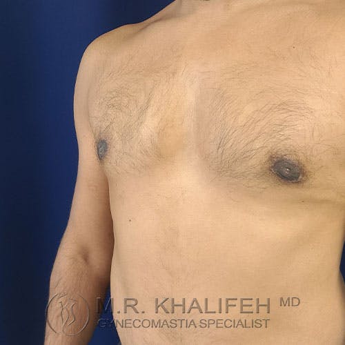 A shirtless male torso is shown in front of a blue background, with slight chest hair and visible nipples. The watermark reads "M.R. Khalifeh MD, Gynecomastia Specialist.
