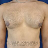 A male torso with visible breast tissue, indicative of gynecomastia, against a blue background. Text at the bottom reads "M.R. Khalifeh MD, Gynecomastia Specialist.