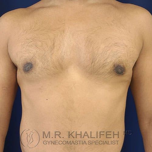Bare chest of an adult male showing mild gynecomastia, with slight enlargement of breast tissue. Logo at bottom reads "M.R. Khalifeh MD Gynecomastia Specialist.
