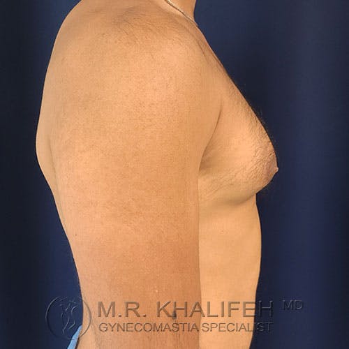 Side view of a shirtless male torso with visible breast tissue, against a dark background. Text at bottom reads "M.R. Khalifeh MD Gynecomastia Specialist.