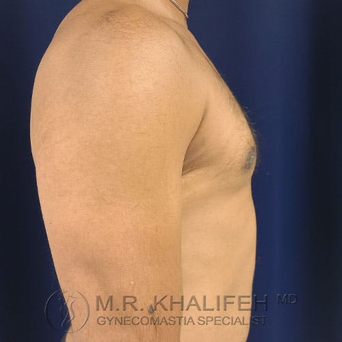 Side profile of a shirtless male torso with visible gynecomastia against a dark blue background; doctor's watermark present at the bottom.