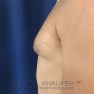 Side profile of a man's bare chest showing gynecomastia, with visible breast tissue enlargement against a blue background.