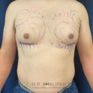 A man's torso with pre-surgical markings on the chest, indicating planned areas for gynecomastia surgery.