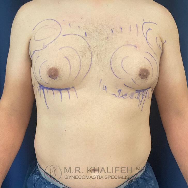 A man's torso with pre-surgical markings on the chest, indicating planned areas for gynecomastia surgery.