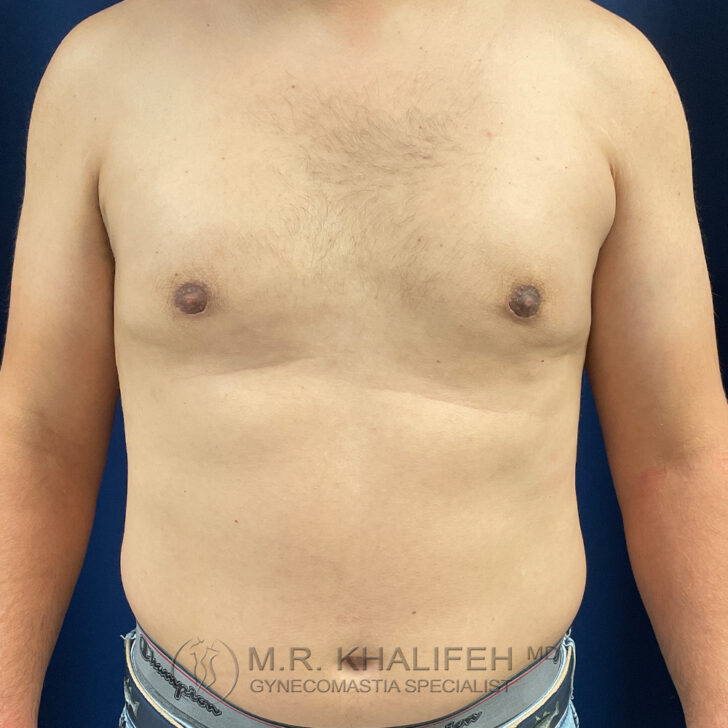 A shirtless adult male torso with visible chest swelling is shown against a dark background. Text at the bottom reads "M.R. Khalifeh MD Gynecomastia Specialist.