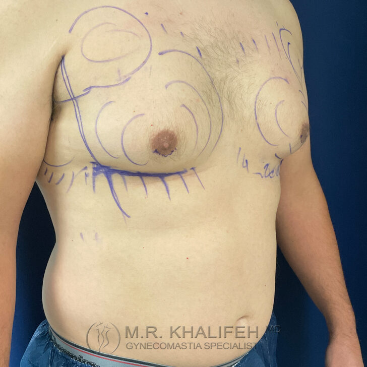 A male torso with surgical markings on the chest and abdomen, indicating planned areas for a medical procedure.