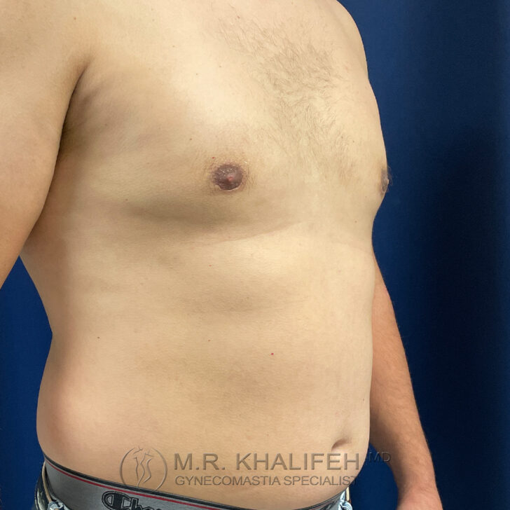 A shirtless adult male torso shown from the side, with visible excess breast tissue and some body hair.
