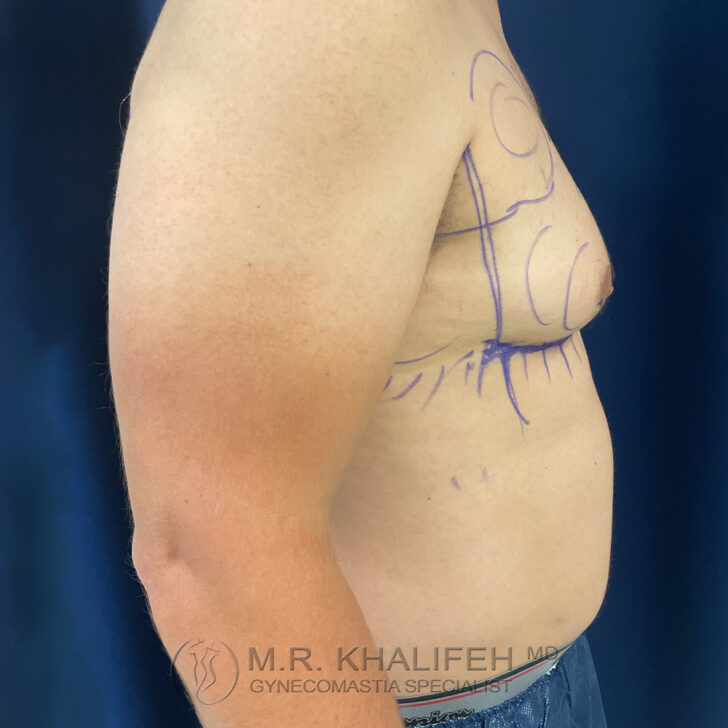 A man's side torso with gynecomastia markings on the chest and visible tan lines on the upper arm.