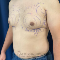 A man's chest and torso are marked with blue surgical lines, indicating planned gynecomastia surgery.