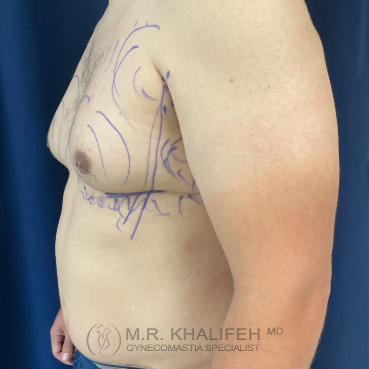 A man’s torso and arm with surgical markings on the chest and side, indicating planned gynecomastia or body contouring procedure. Logo at the bottom reads “M.R. Khalifeh MD Gynecomastia Specialist.”.