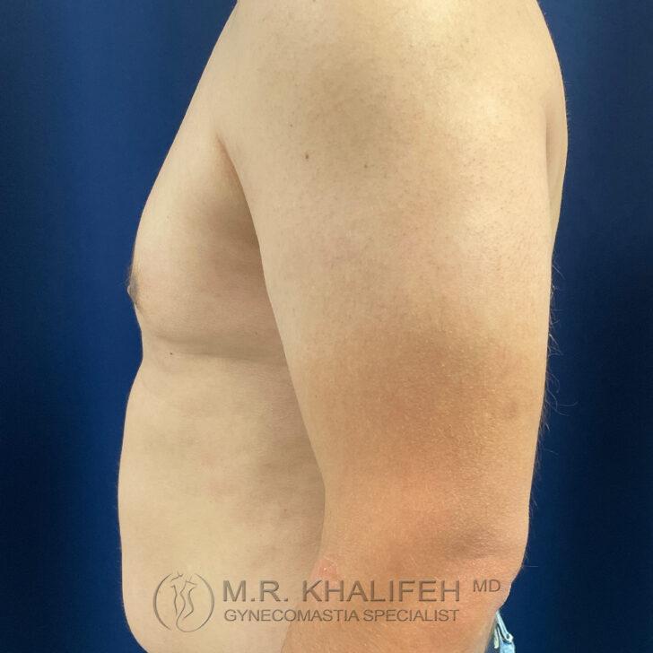 Side view of a shirtless adult male torso against a blue background, showing the chest, arm, and abdomen. Logo and text for "M.R. Khalifeh MD Gynecomastia Specialist" are visible.