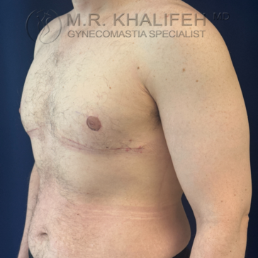 Man with visible chest and abdominal surgical scars, standing shirtless against a blue background. Text overlay reads: "M.R. Khalifeh MD Gynecomastia Specialist.