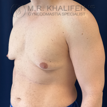 A shirtless man with visible gynecomastia stands against a dark background; physician and gynecomastia specialist’s branding appears at the top of the image.