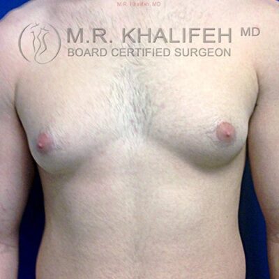 A shirtless person with enlarged breast tissue stands facing forward. The image has a watermark for a board certified surgeon named M.R. Khalifeh, MD.