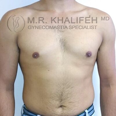 A shirtless adult male stands facing forward, showing his chest and abdomen. The watermark reads "M.R. Khaliféh MD, Gynecomastia Specialist.