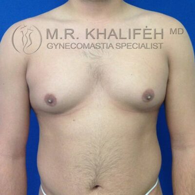 A shirtless person with visible gynecomastia, standing against a blue background. The watermark reads "M.R. Khaliféh MD Gynecomastia Specialist.