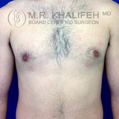 A person's bare chest and upper abdomen are shown against a blue background, with text overlay indicating a board-certified surgeon.
