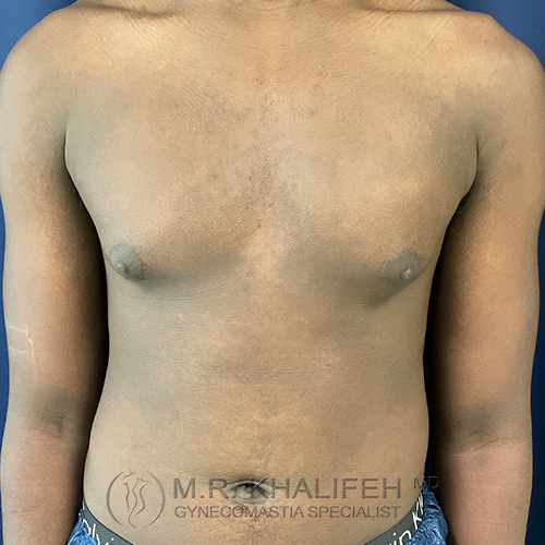 A person with visible breast tissue enlargement in the chest area, suggestive of gynecomastia, standing against a plain blue background.