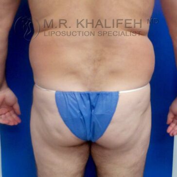 A person stands with their back to the camera wearing a blue disposable garment, exposing the back, hips, and thighs against a blue background.