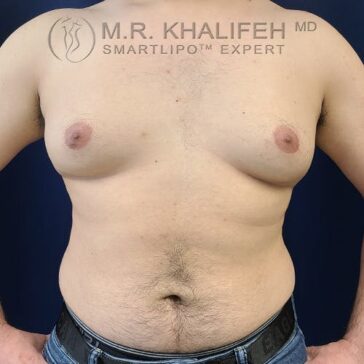 A shirtless person with visible gynecomastia stands against a dark blue background, showing the chest and abdomen from the waist up.