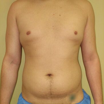 A shirtless person with a visible abdomen and slight body hair stands against a plain background, wearing blue shorts.