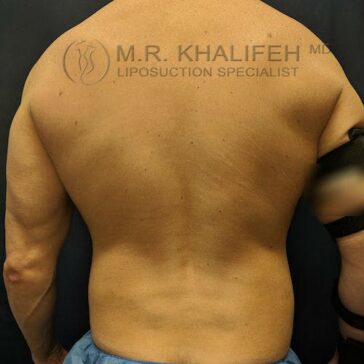 A person’s bare back is shown with mild skin folds and an arm partially wrapped in a black compression garment. "M.R. Khalifeh, MD Liposuction Specialist" is watermarked on the image.