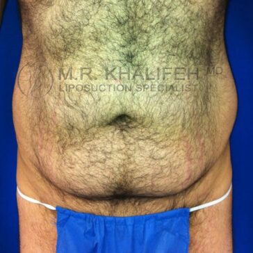 A close-up view of a person's hairy abdomen with loose skin, standing against a blue background, wearing a blue cloth and white waistband.