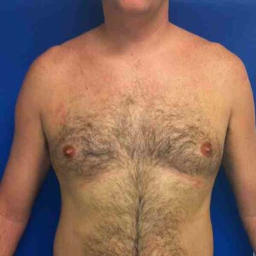 A shirtless adult male with excess tissue on the chest, suggestive of gynecomastia, standing against a blue background.
