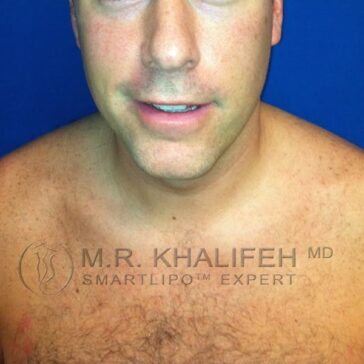 A man with short hair and no shirt is facing the camera against a blue background. Text overlay reads "M.R. Khalifeh MD SmartLipo Expert.