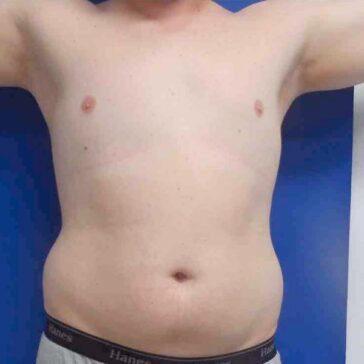 A shirtless person with their arms raised stands against a blue background, displaying their bare torso and abdomen.