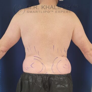 Person shown from behind with surgical markings on the lower back and flanks, wearing a black garment, against a dark background.