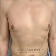 A person’s bare chest is shown facing forward with both arms at their sides. The image includes a watermark for Dr. M.R. Khalifeh, gynecomastia specialist.