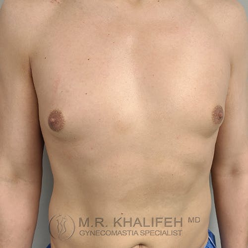 A person’s bare chest is shown facing forward with both arms at their sides. The image includes a watermark for Dr. M.R. Khalifeh, gynecomastia specialist.