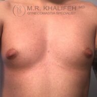 A close-up of a person's bare chest showing enlarged male breast tissue, with a watermark reading "M.R. Khalifeh MD Gynecomastia Specialist" at the top.