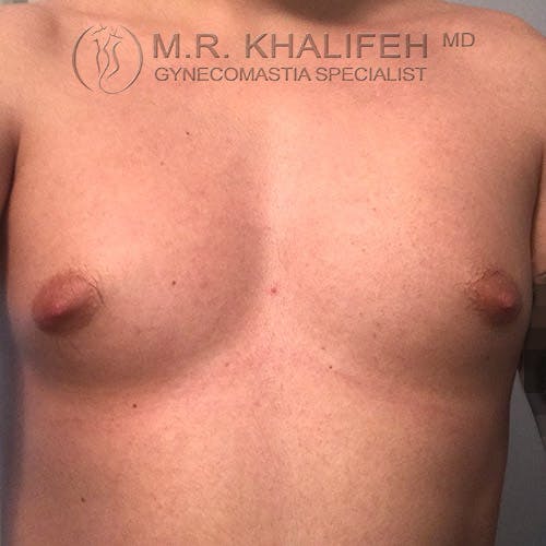 A close-up of a person's bare chest showing enlarged male breast tissue, with a watermark reading "M.R. Khalifeh MD Gynecomastia Specialist" at the top.