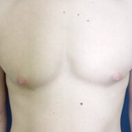 Bare chest and torso of a person with no visible clothing, showing skin, nipples, and several small moles.