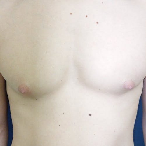 Bare chest and torso of a person with no visible clothing, showing skin, nipples, and several small moles.