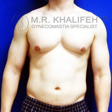 A shirtless man with visible enlarged breast tissue stands against a blue background, displaying signs of gynecomastia.
