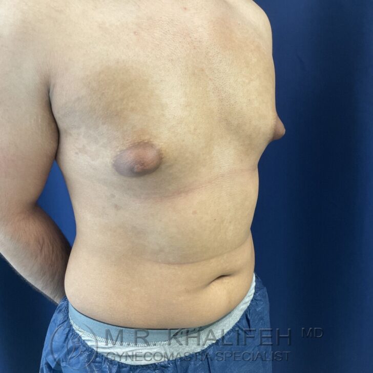 A person with visible gynecomastia on the left side of the chest, standing sideways against a blue background, wearing medical shorts.