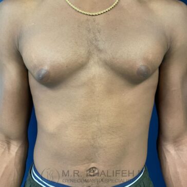A shirtless person with enlarged breast tissue (gynecomastia) stands against a blue background, wearing a chain necklace and dark shorts. The image includes a watermark at the bottom.