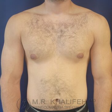 A shirtless man stands facing forward against a blue background, with visible chest hair and the logo "M.R. Khalifeh MD Gynecomastia Specialist" at the bottom.