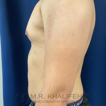 A shirtless person stands in profile against a blue background, showing a flat chest and visible skin marks on the upper torso.