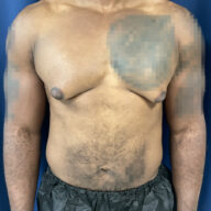 A person standing against a blue background with visible gynecomastia and areas of blurring over the left chest and lower abdomen.
