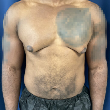A person standing against a blue background with visible gynecomastia and areas of blurring over the left chest and lower abdomen.